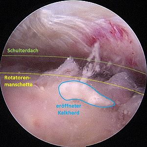 Bild Arthroskopisches Bild eines eröffneten Kalkherdes