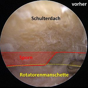 Bild 1 Arthroskopische Abtragung des Knochensporns vorher