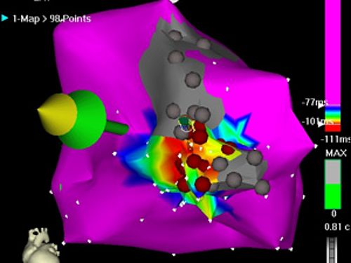 VT Ablation der linken Herzkammer: Ein zwischen zwei Narbenfeldern (grau) liegender „Kurzschluss“ (Reentry) wird abladiert (rote Markierungen).