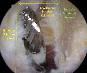 Bild OP Schultereckgelenk