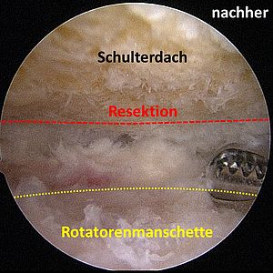 Bild 2 Arthroskopische Abtragung des Knochensporns nachher