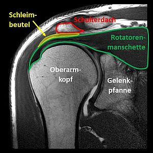 Bild Impingement MRT