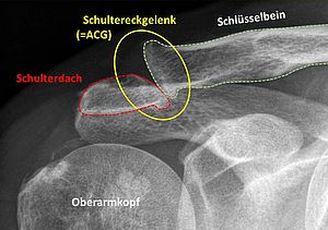 Bild Röntgenaufnahme Arthrose Schultergelenk