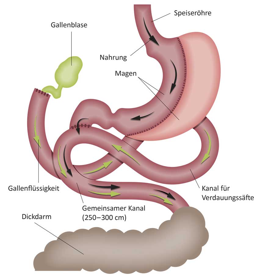 Grafik: Operationsmethode SADI-S